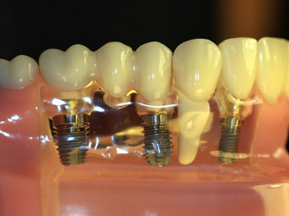 Имплантация как современный метод восстановления зубов