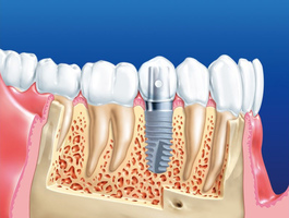 Зубные имплантанты: эффективное средство регенерации